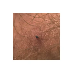 Liteway Tick Remover Tool